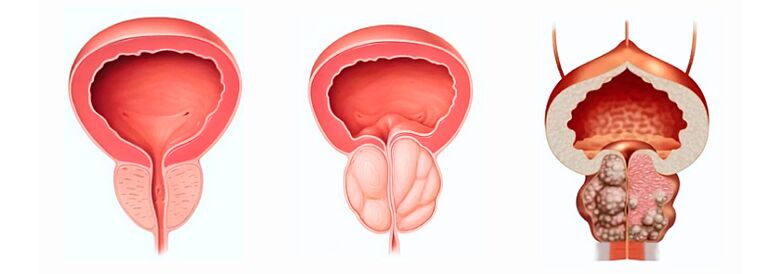 Faze razvoja adenoma prostate